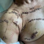 Radio Virsa Harnek Singh_injuries